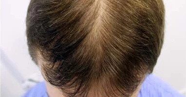 Progreso del cabello en el primer mes de tratamiento con Profolan